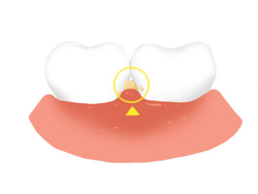 継続が重要　歯周病を防ぐ予防歯科について