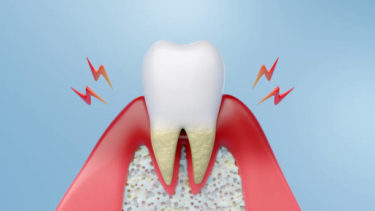 歯周病の進行段階と治療法