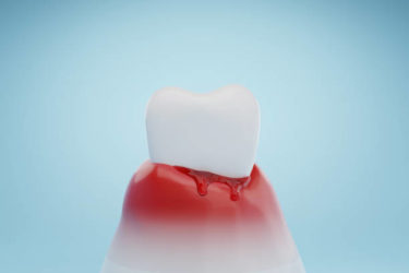 歯周病を予防するには？